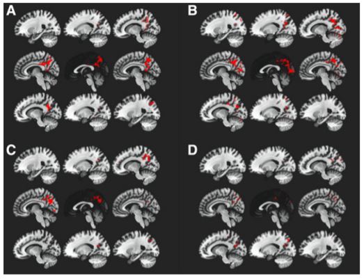 photobiomodulation outcomes cerebral blood flow