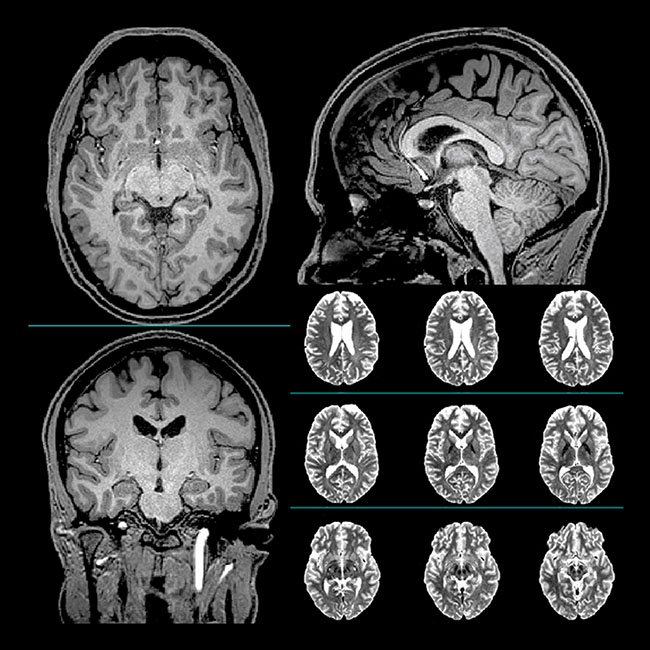 MRI brain baseline Chao study 2020